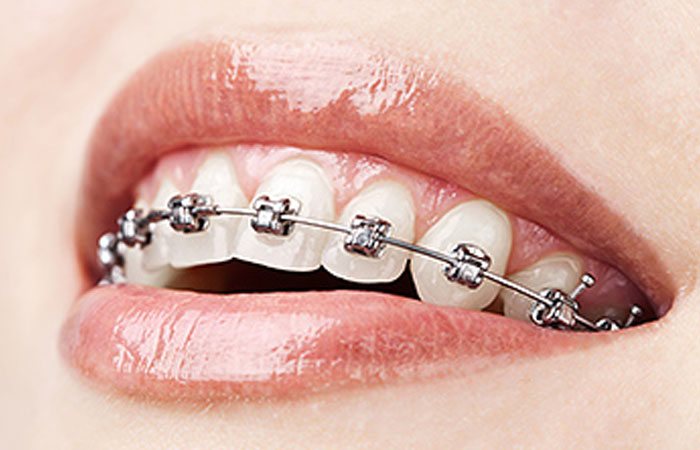 Self Ligating Braces