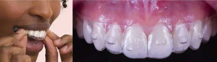 Ceramic Braces