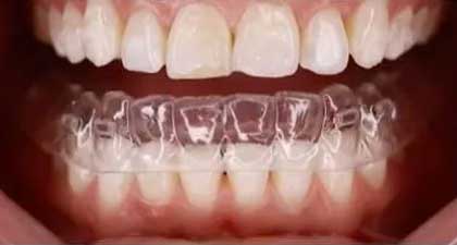 Ceramic Braces