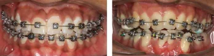 Ceramic Braces